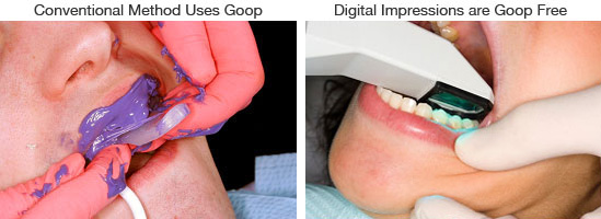 conventional-digital-impressons iTero™ Digital Impressions