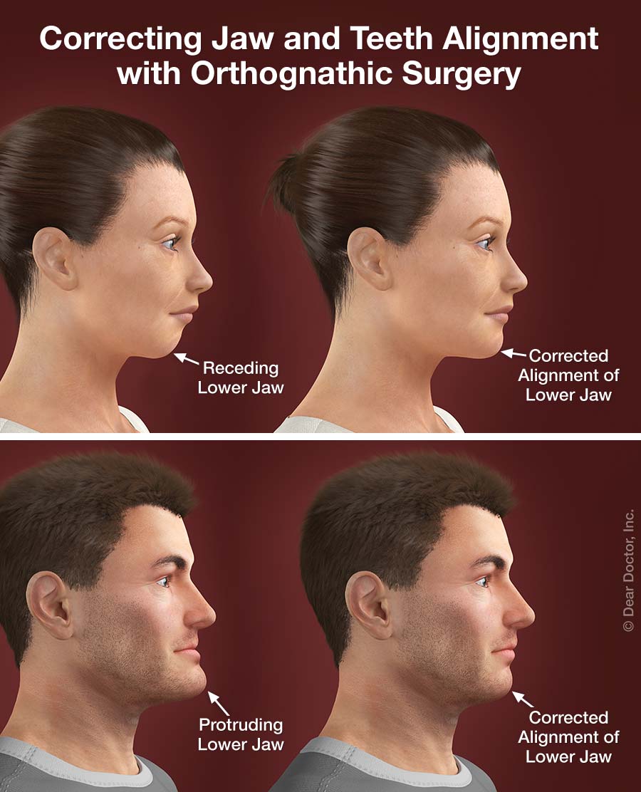 Surgical Orthodontics
