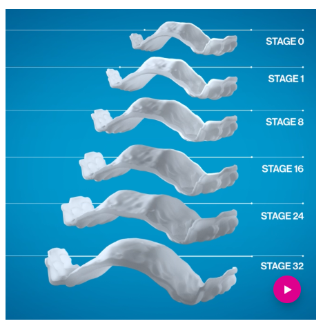 Invisalign Palatal Expander