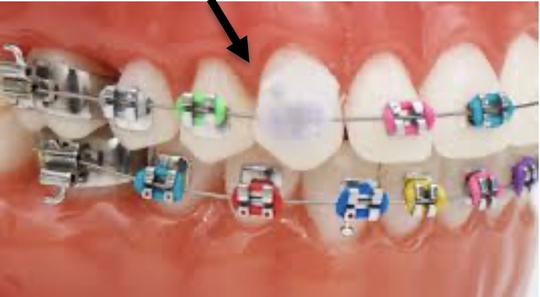 Close-up of a patient's braces with colorful elastic ties on the brackets