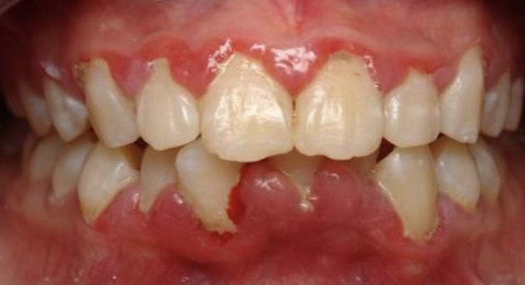 Close-up of inflamed, swollen gum tissue around the front teeth