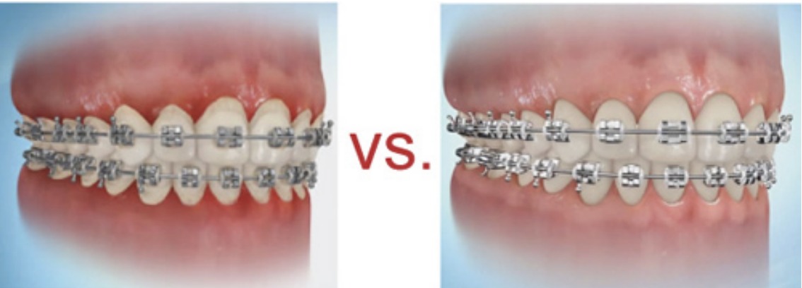 Side by side comparison of braces on healthy pink gums versus braces on inflamed, plaque-covered gums