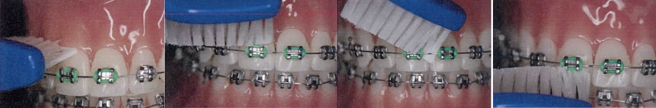 A four-step close-up sequence of a blue toothbrush cleaning above and below a bracket with a green elastic tie