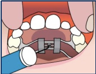 Illustration of the key being placed into the hole of the expander