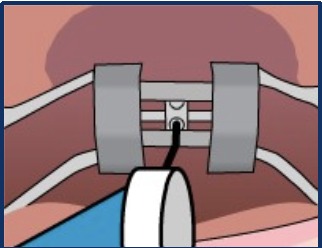 Illustration of the key pushed toward the back of the mouth to rotate the expander wheel