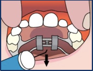 Illustration showing the key being removed back and down toward the tongue