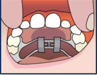 Illustration of a child tipping their head back to view the expander
