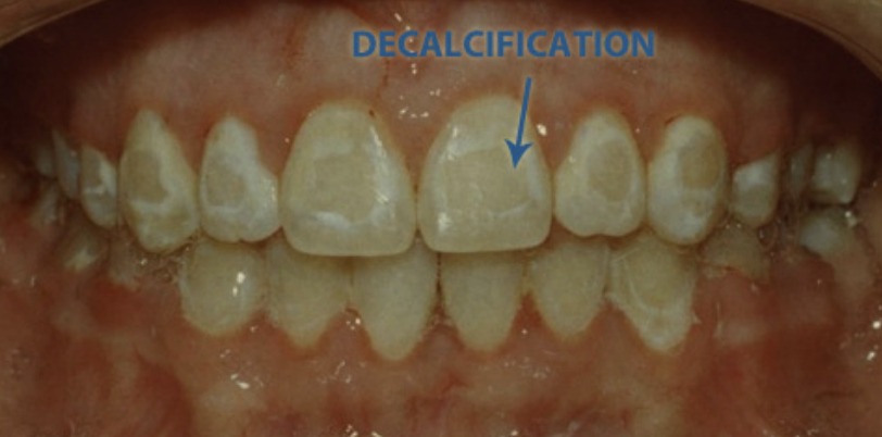 An orthodontist showing a dental model of an expander to a mother and her son at a consultation