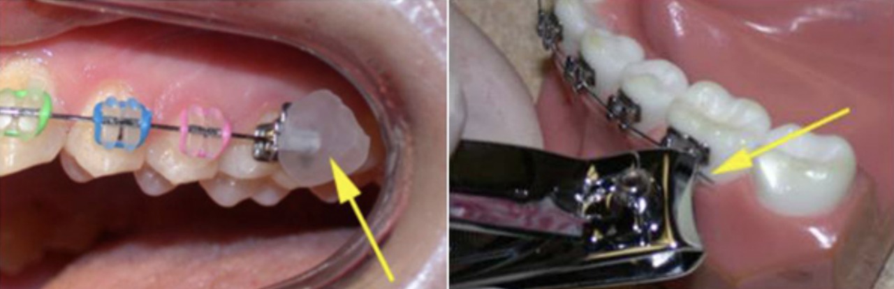 Dental pliers trimming the end of a wire near a molar bracket