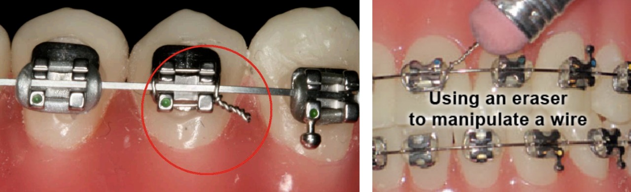 Using a pencil eraser to press a small wire end toward the teeth