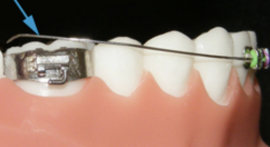 A blue arrow pointing to the end of a wire near the back molar tube on the upper arch