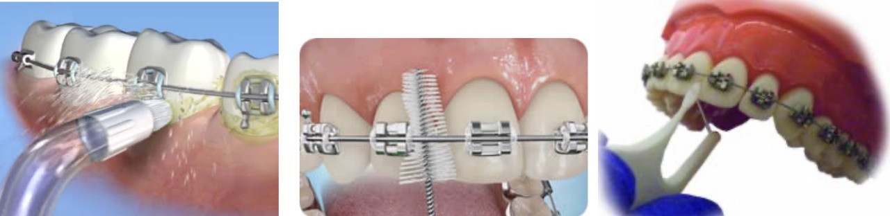 Three illustrations showing a water flosser tip, a proxy brush between teeth, and a water flosser angled under a wire