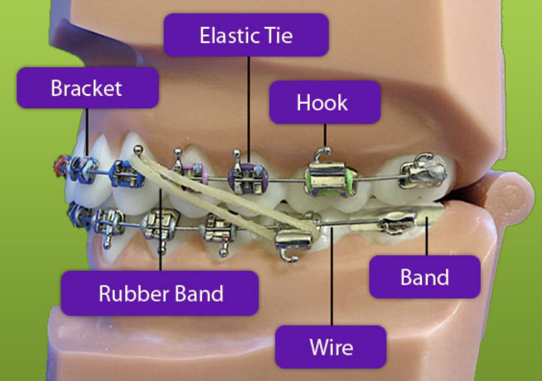 Labeled diagram of braces parts: bracket, elastic tie, hook, rubber band, wire, and band